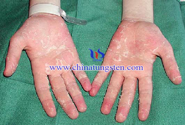 image of Acrodynia caused by elemental mercury